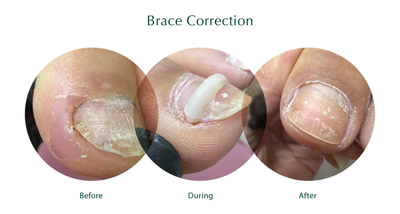 Brace Correction Brace Correction