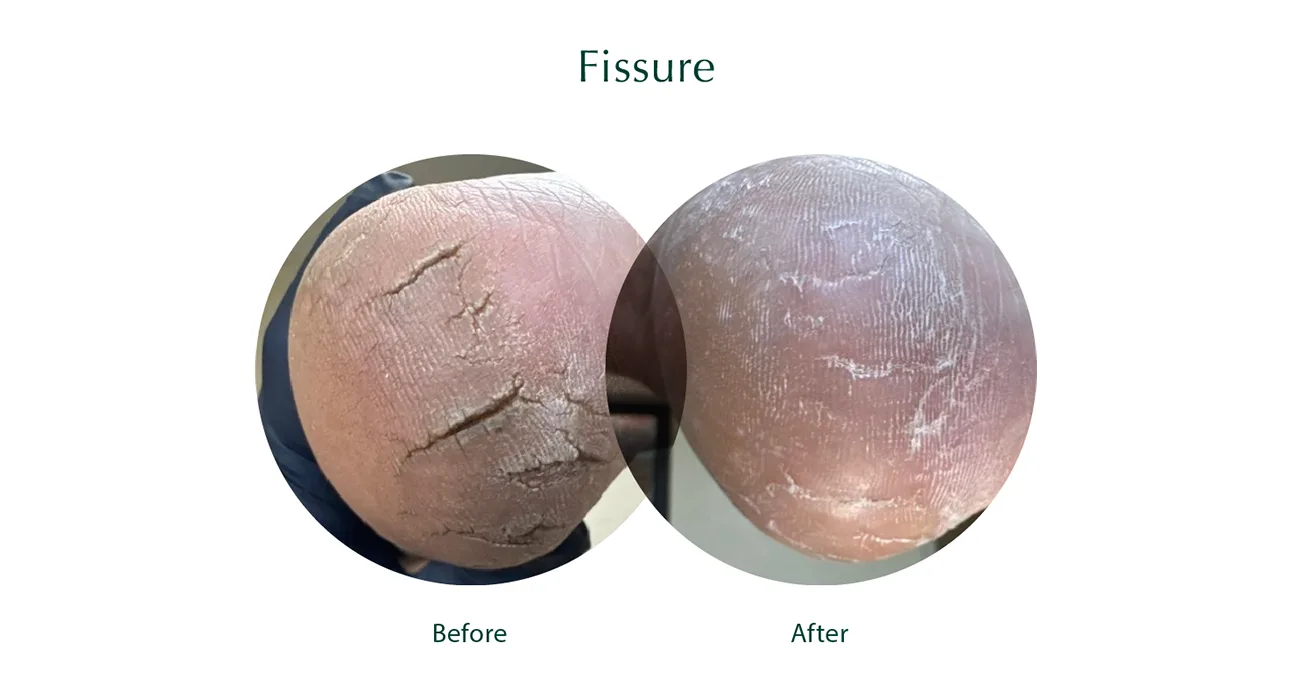 Fissure Fissure