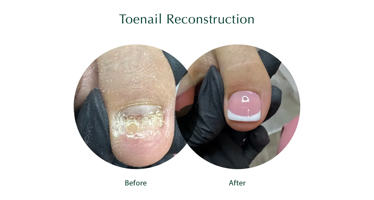 Toenail Reconstruction Toenail Reconstruction
