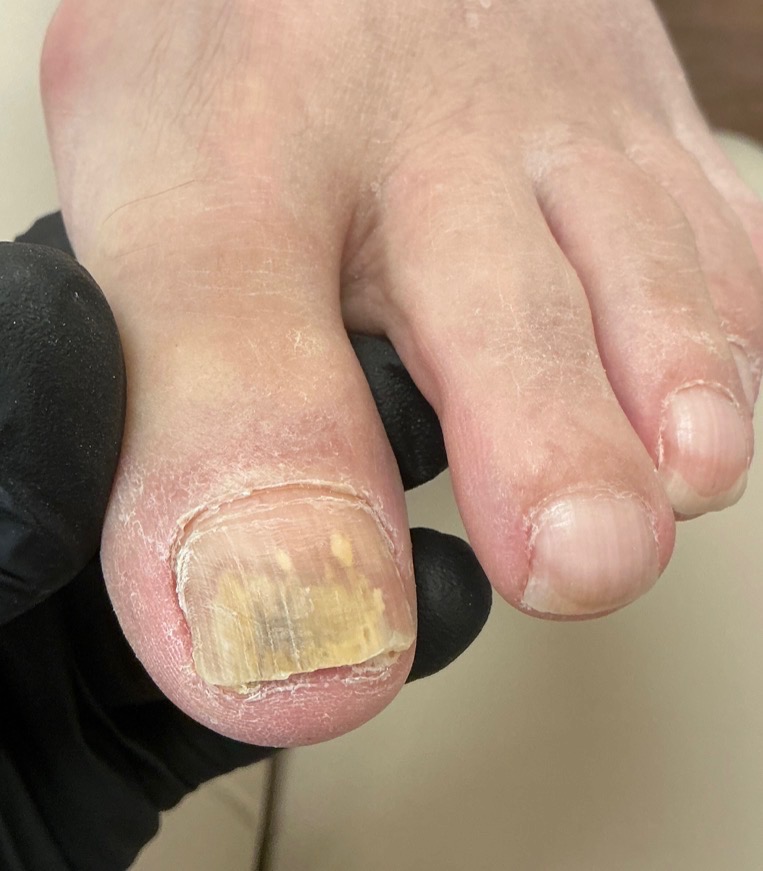 Client’s toenail after the most recent pedicure
