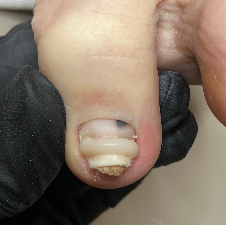 Front view of a toenail with an ONYFIX correction band