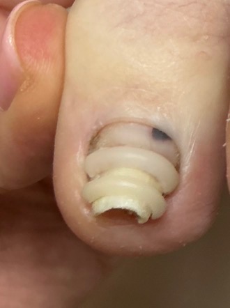 Close-up of the client’s toenail with correction bands visible