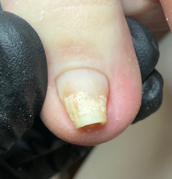Front view of the client’s toenail during care