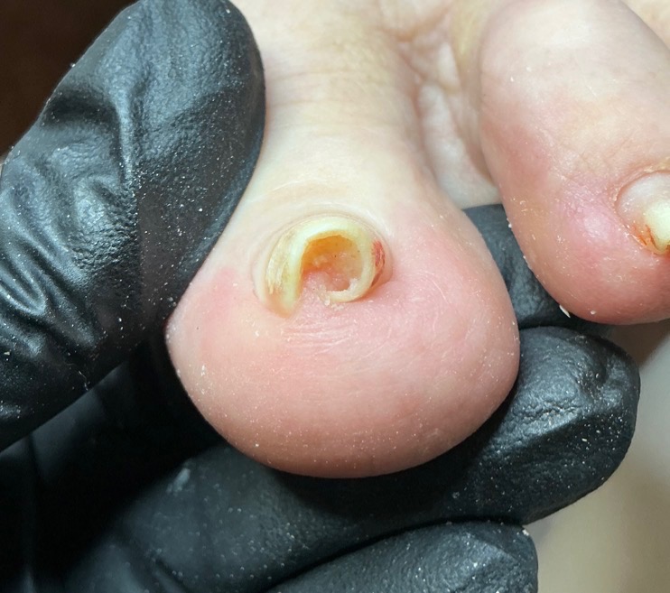 Close-up of a toenail with edges curving inward
