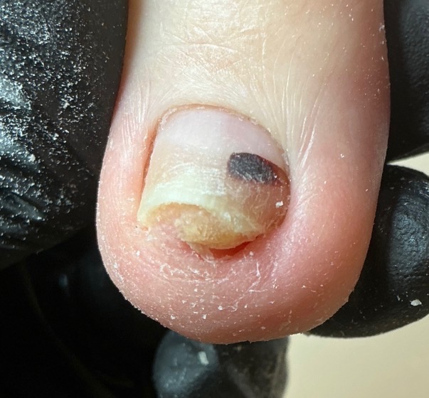 Close-up of the client’s toenail and surrounding skin